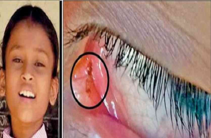लड़की की आंखों से निकल रहा है कुछ एेसा, डाक्टर भी हैं हैरान